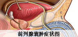 男性前列腺囊肿疾病会传染吗